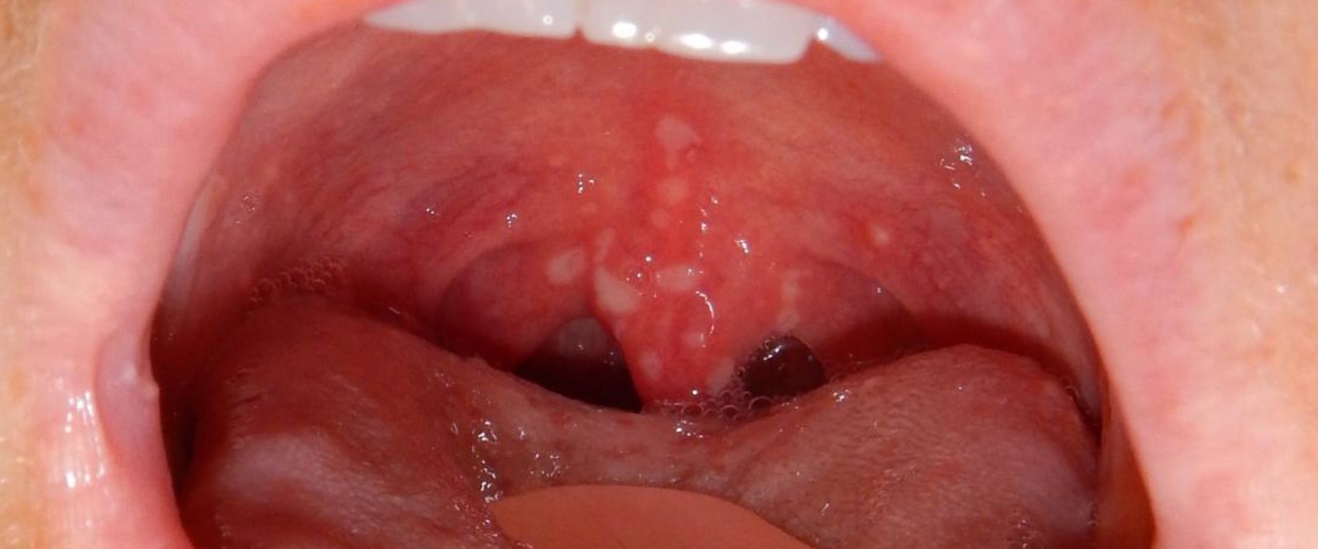 mouth-sores-types-causes-and-more